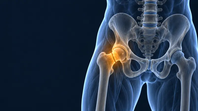 Render médico de la pelvis con el cuello del fémur fracturado iluminado